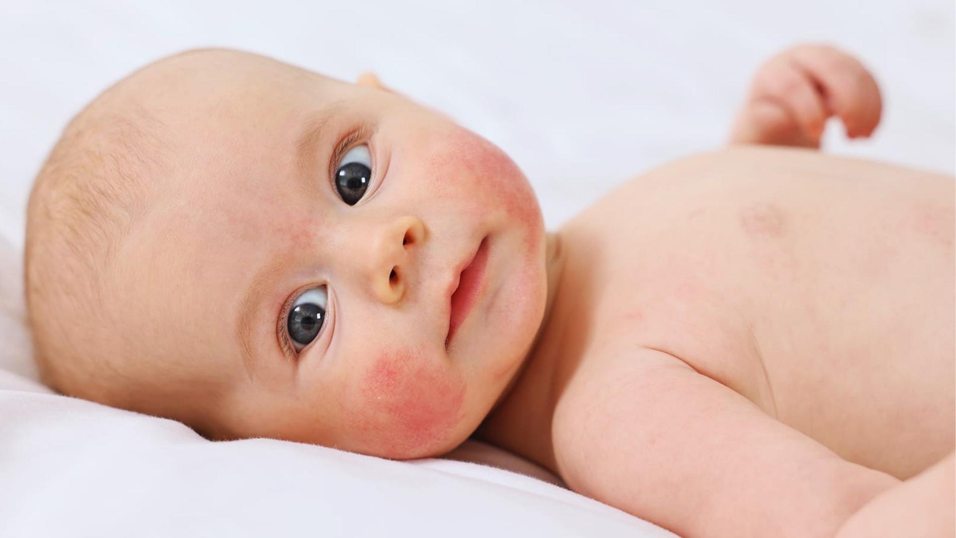 Baby with light skin and red cheeks on face and chest lies on white sheet.