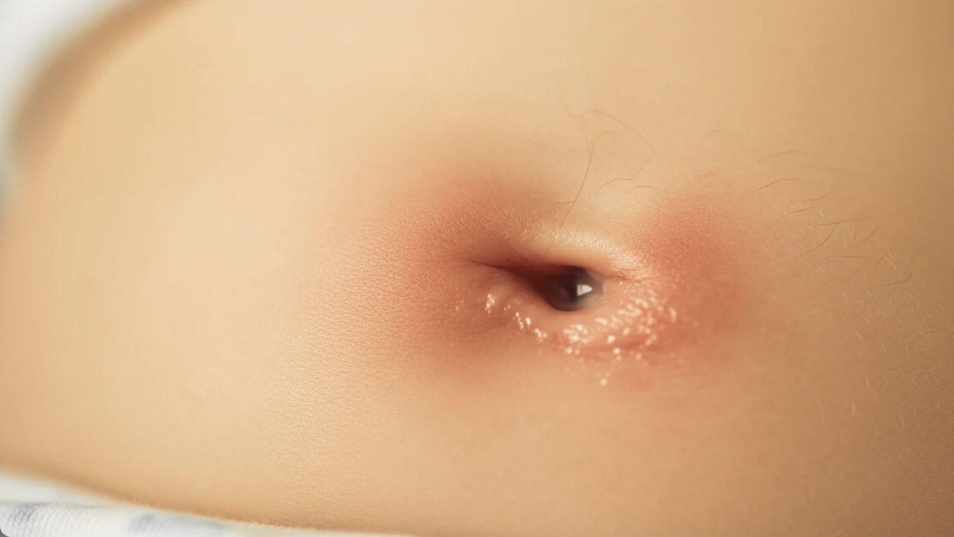 Newborn baby belly button showing redness, irritation, and discharge around navel, possible signs of umbilical infection
