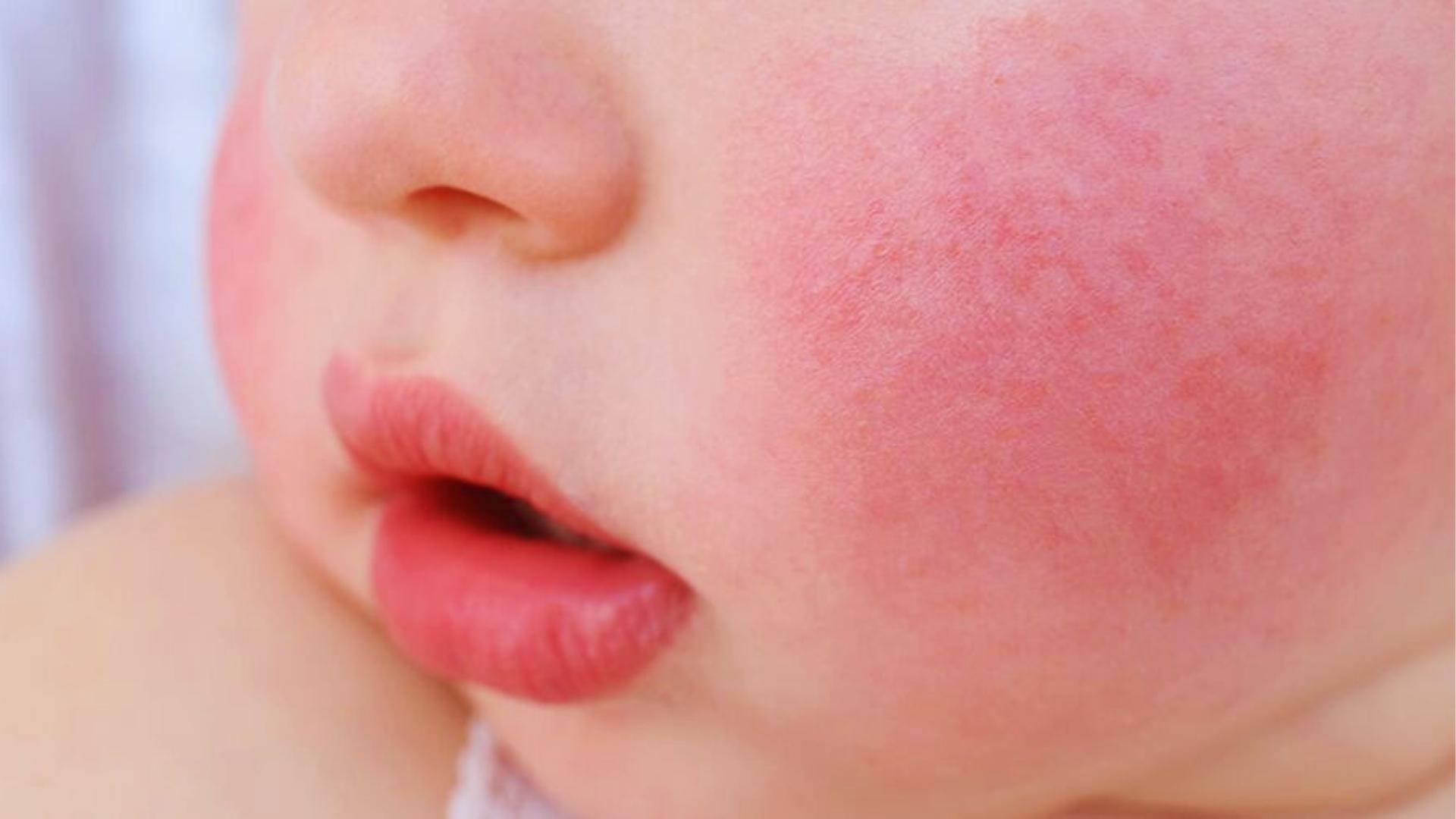 Close-up of baby’s face with bright red cheeks and pink lips, slightly open mouth.