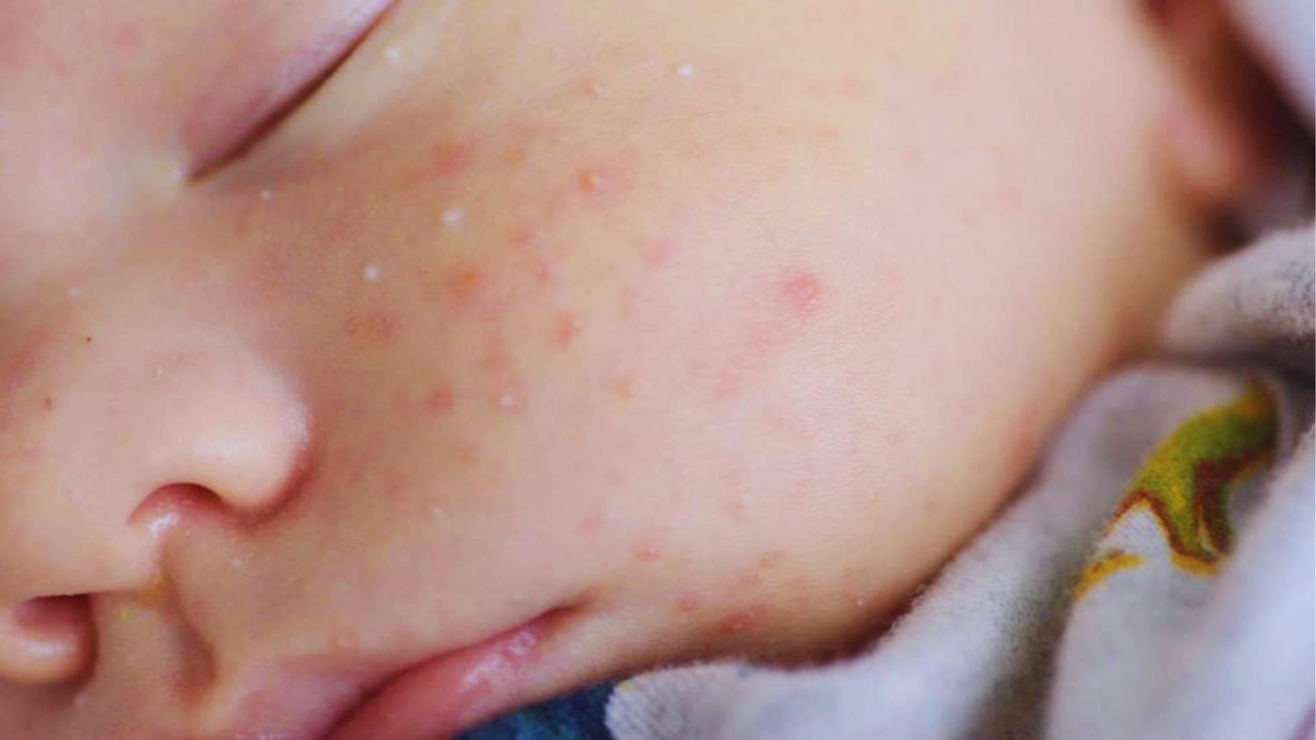 Close-up of sleeping baby’s face with red rash and small white bumps on cheek.