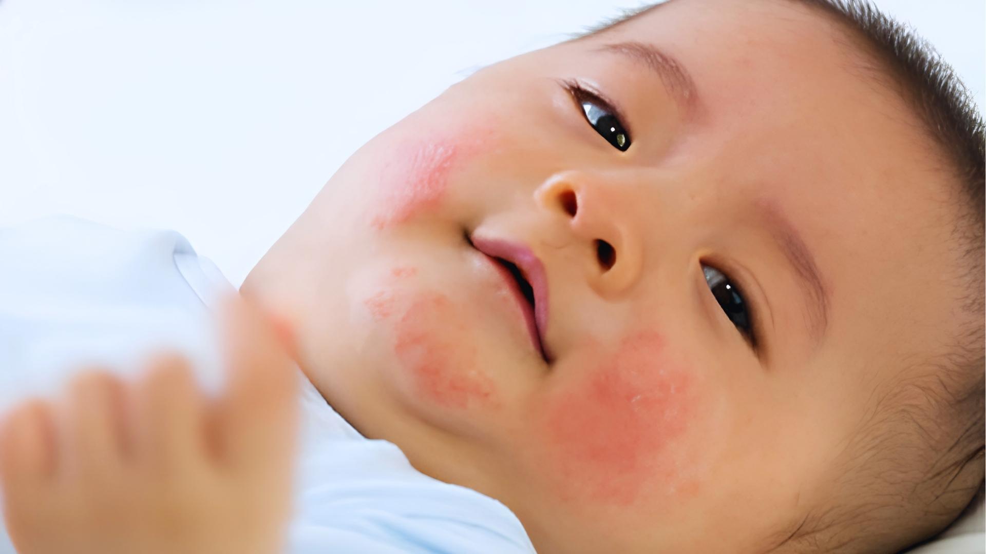 Close-up of baby with red rash patches on cheeks and chin, reaching hand toward camera.