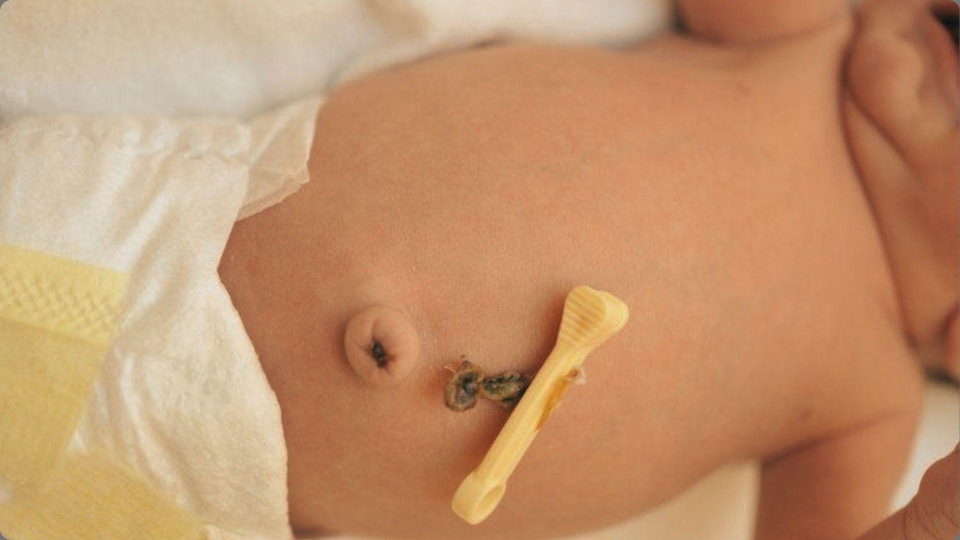 Newborn baby wearing diaper with healing umbilical cord stump and yellow plastic clamp attached near belly button
