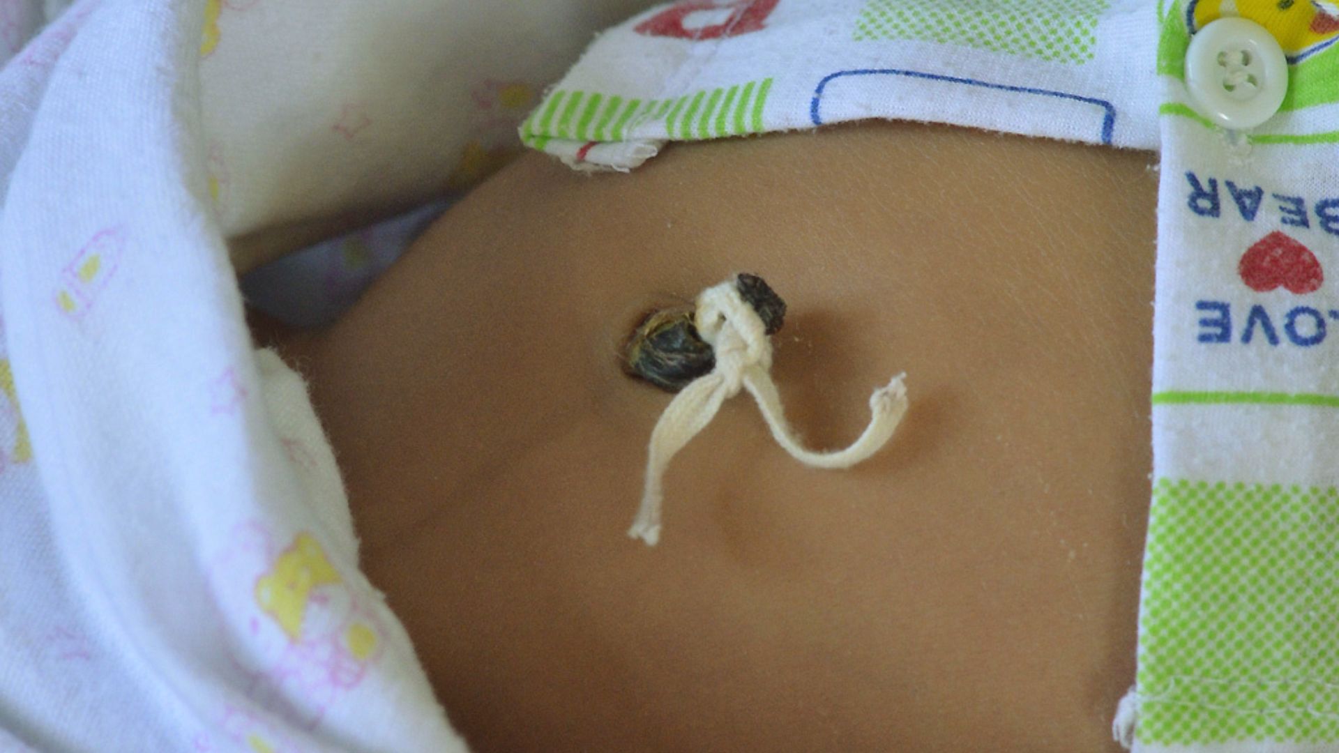 Close-up of newborn's belly with dark umbilical stump tied with white string under patterned clothes
