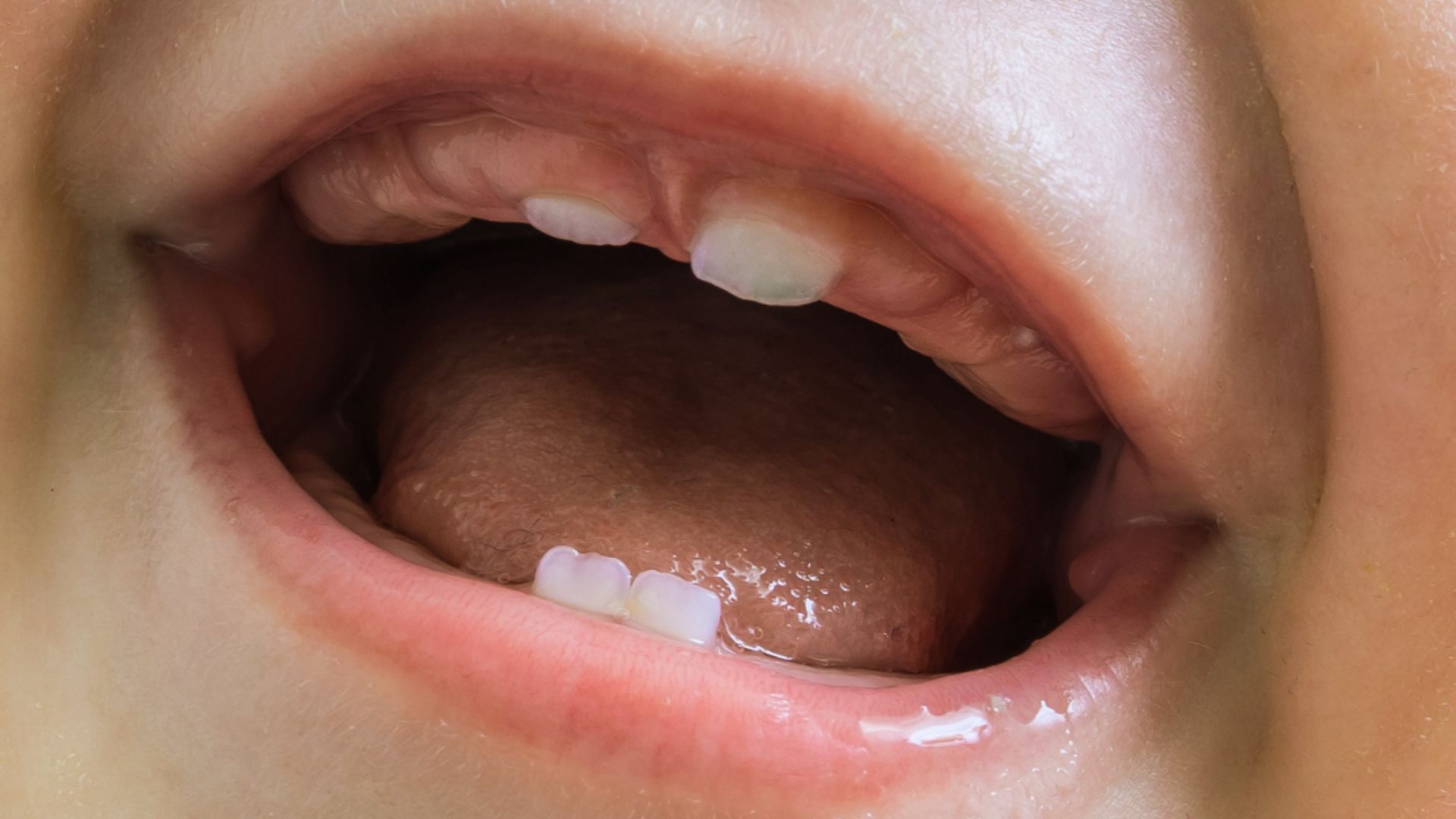 Close-up of a child's open mouth showing upper and lower baby teeth and tongue