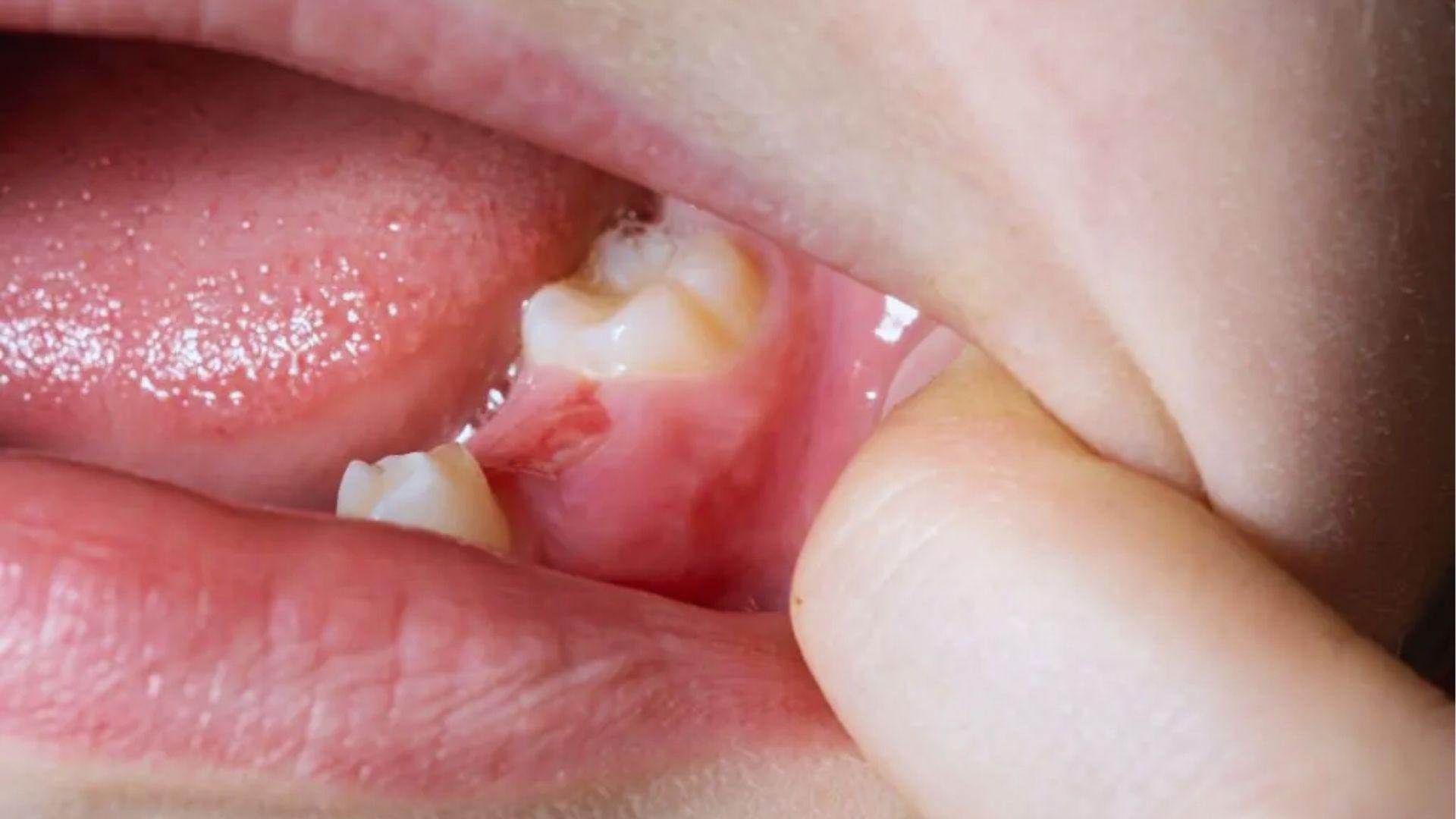 A baby’s lower jaw molars coming in