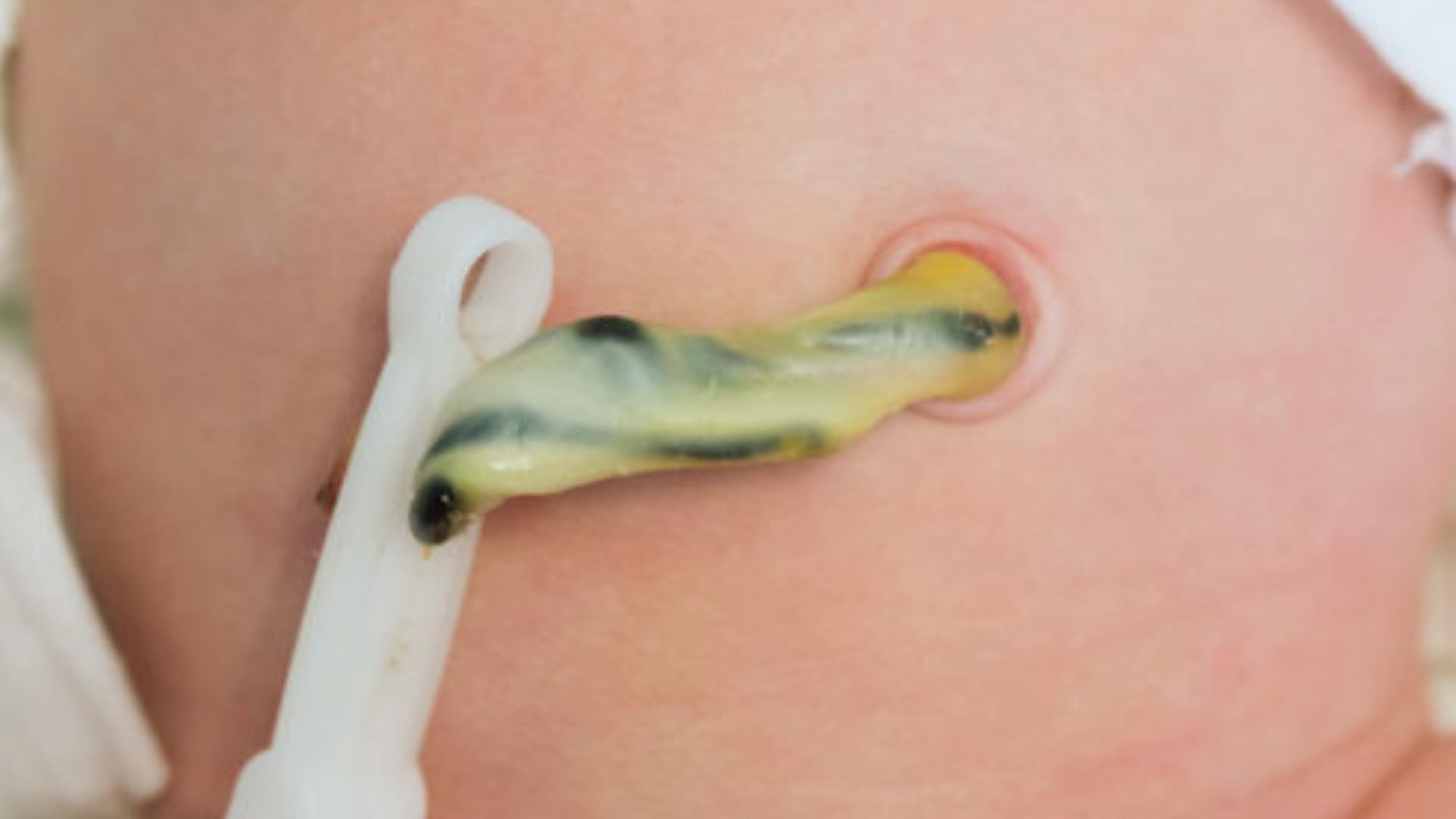 Close-up of newborn's belly with yellowish umbilical cord stump secured by white plastic clamp