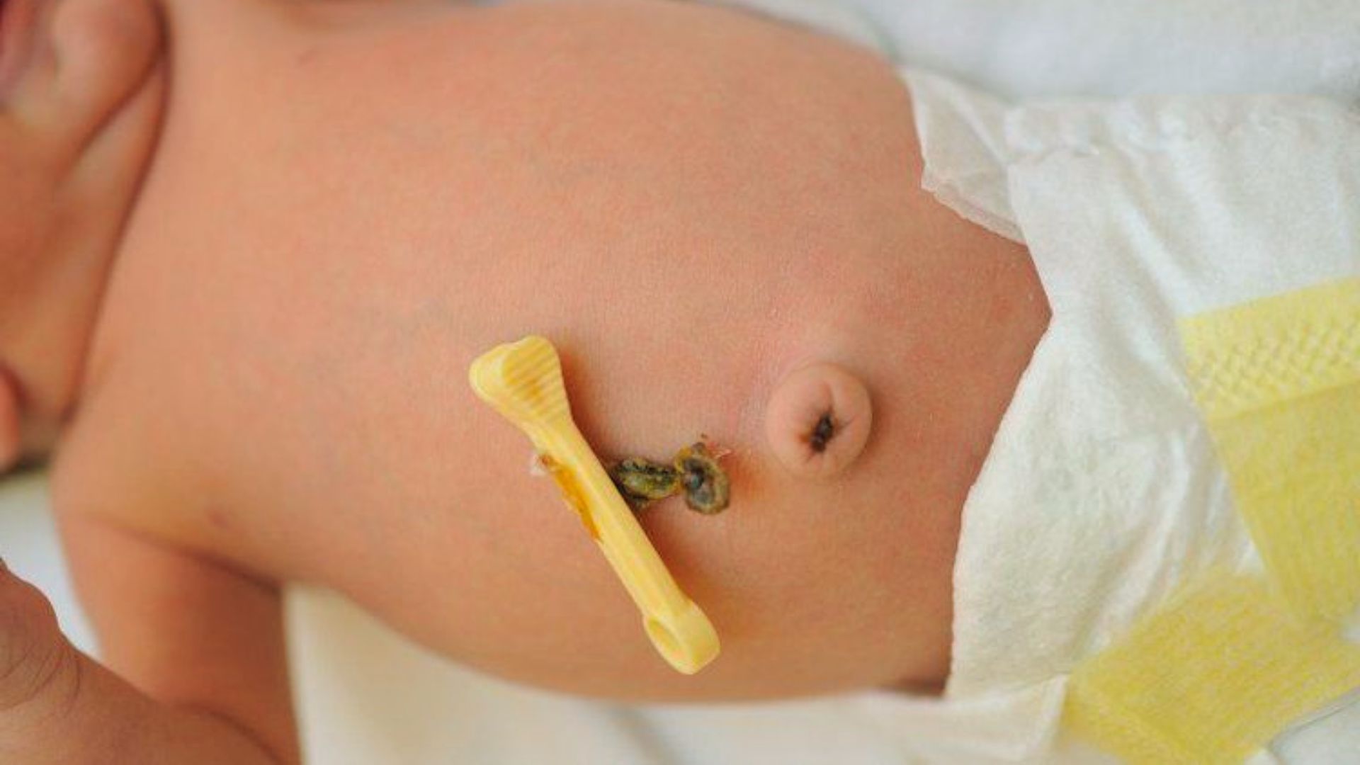 Close-up of newborn baby's belly with umbilical cord stump and yellow plastic clamp beside diaper