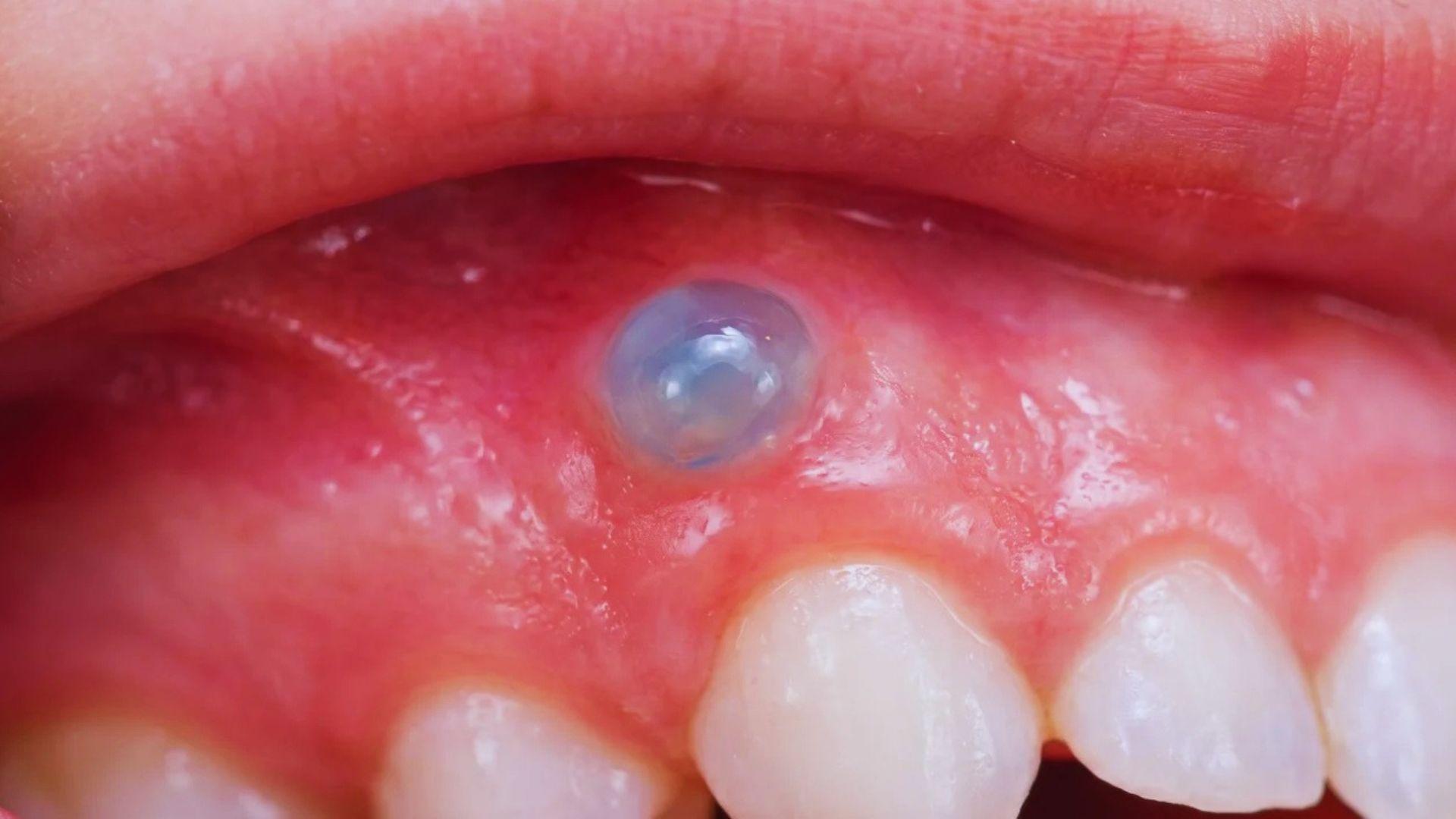 Small bluish raised bump on a baby’s gum above an emerging tooth.