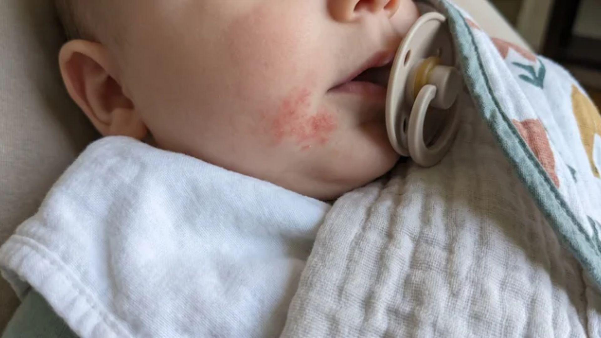 Infant cheek with a red rash beside a pacifier, soft cloth and bib fabric