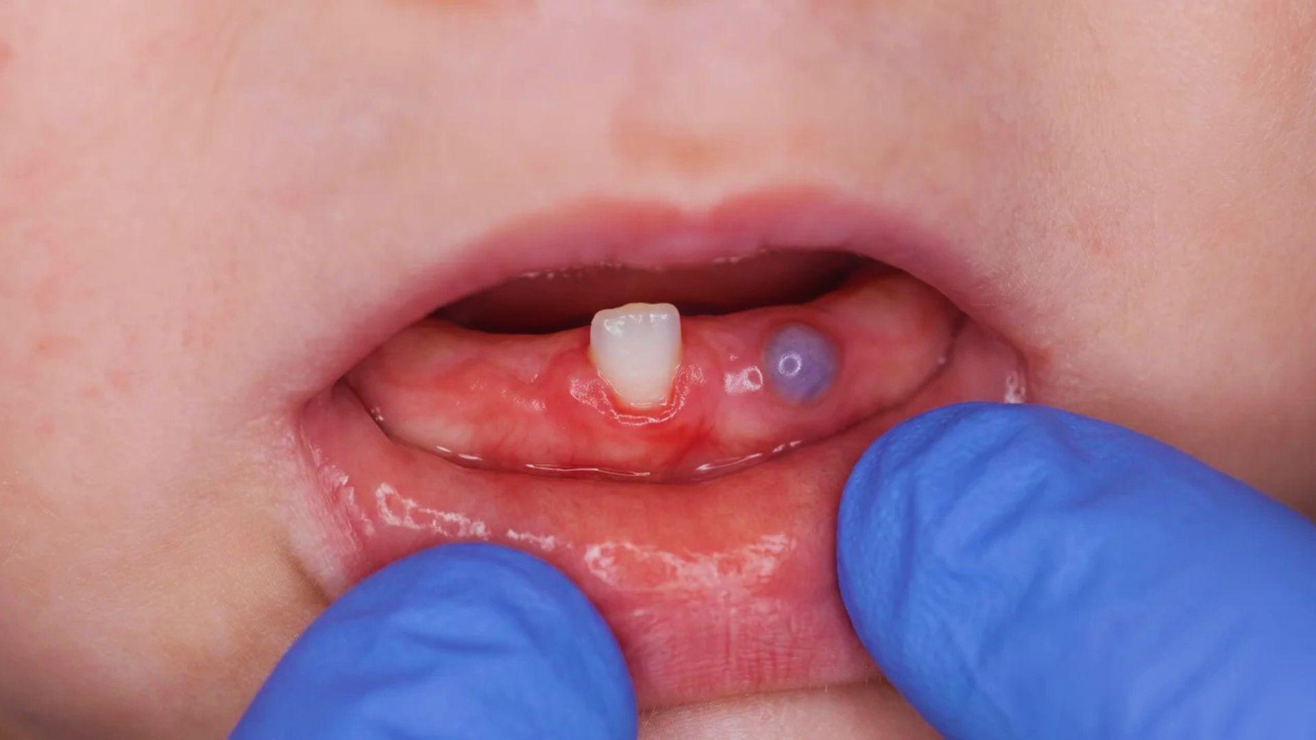 Baby’s gumline showing reddish puffiness and a small bluish bump near an emerging tooth.