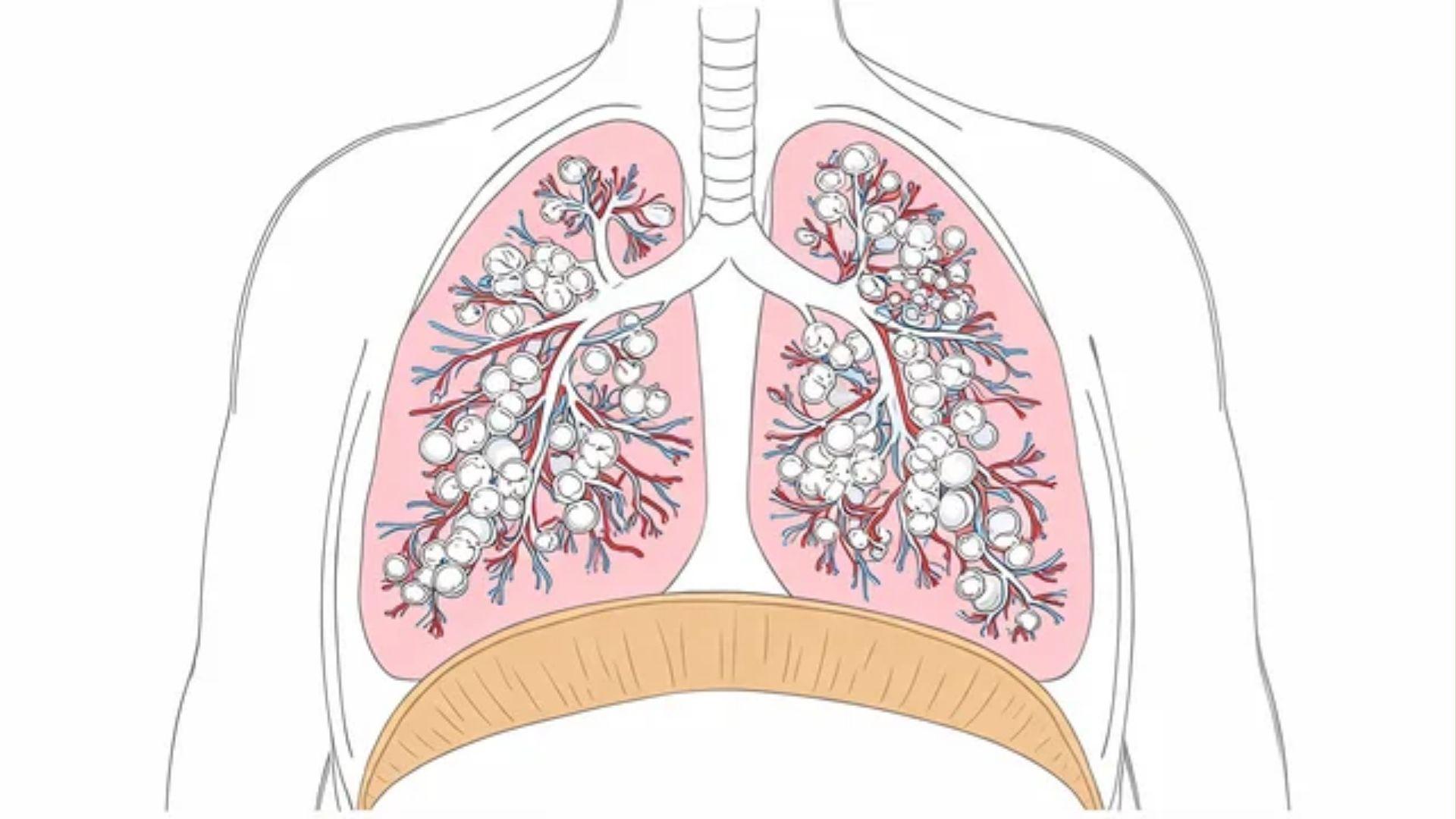 Newborn lungs with alveoli and surrounding blood vessels shown in an anatomical cutaway