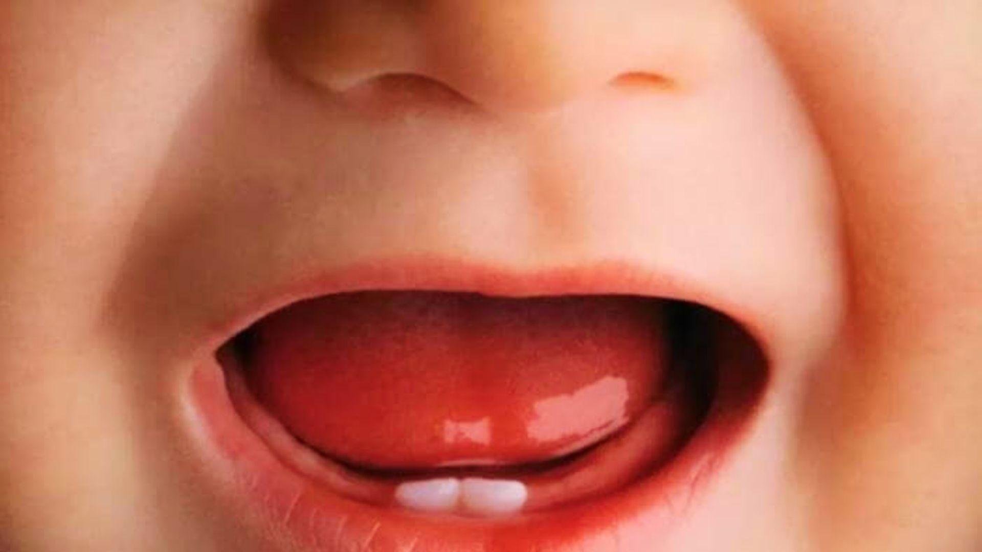 Close-up of infant open mouth showing two lower natal teeth.