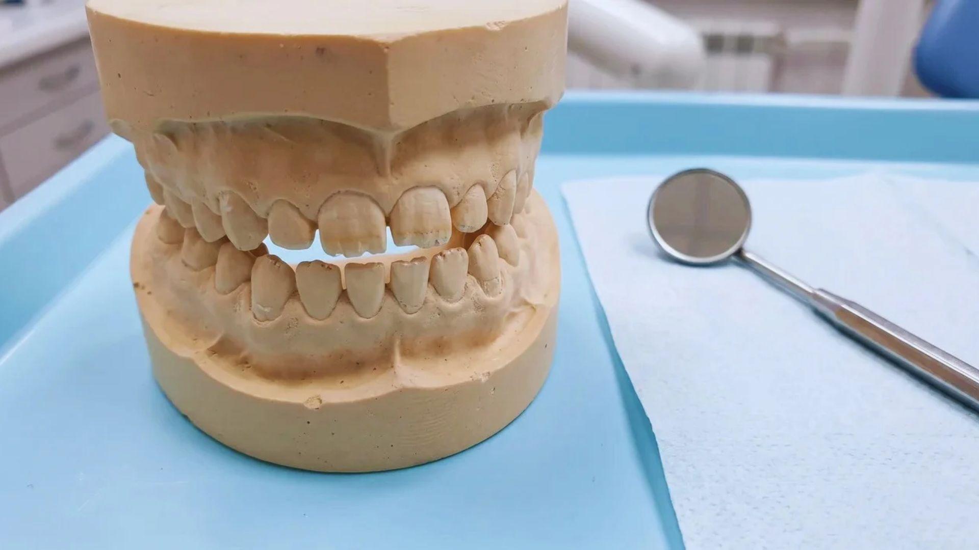 Dental model showing worn baby tooth edges and small chips beside a dental mirror.