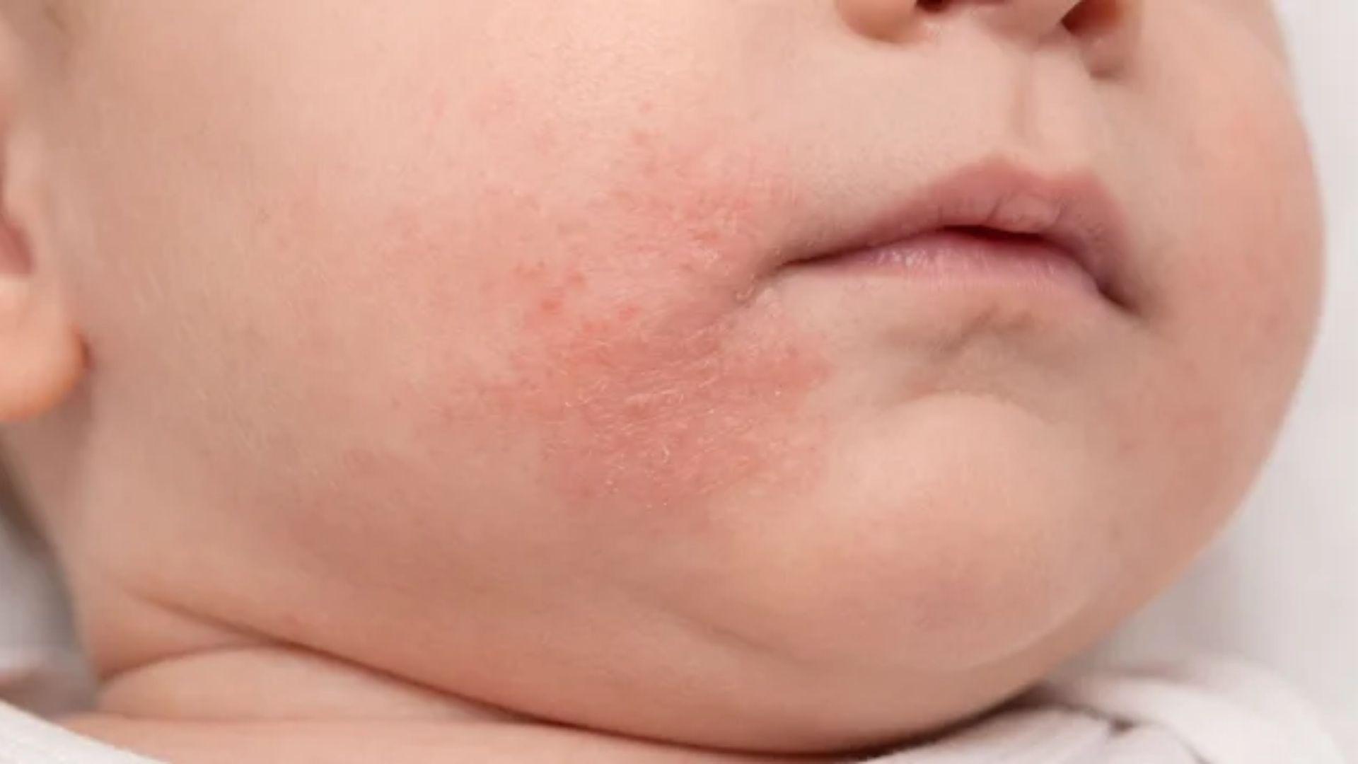 Red, dry, bumpy rash on an infant’s cheek near the corner of the mouth