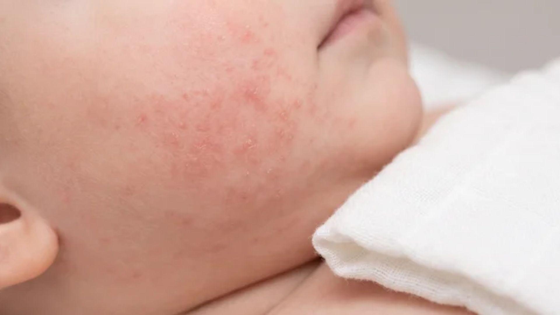 Thin layer of barrier cream on an infant’s red cheek beside a soft dry cloth