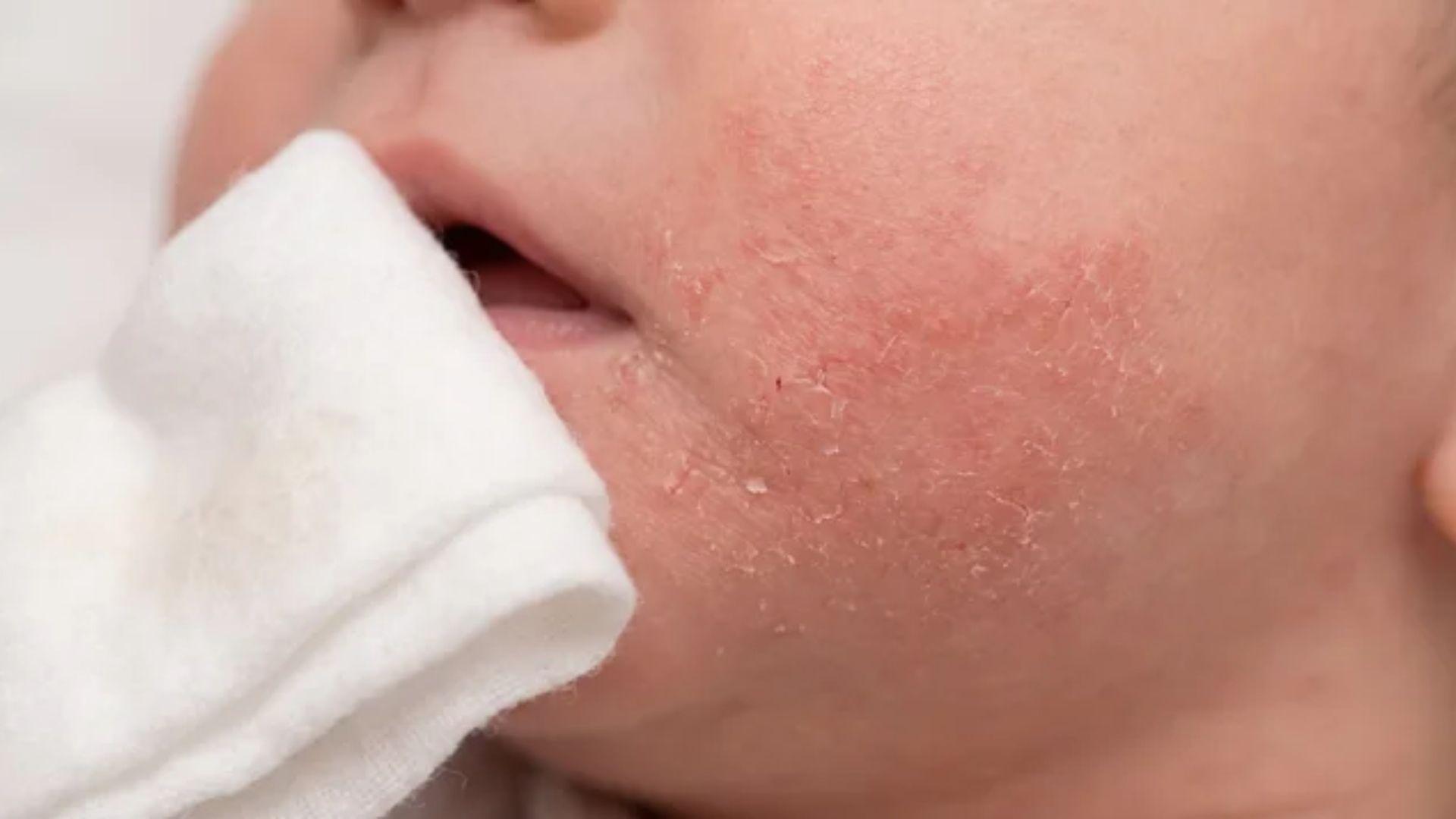 Rough, chapped red skin on an infant’s cheek beside a damp cloth