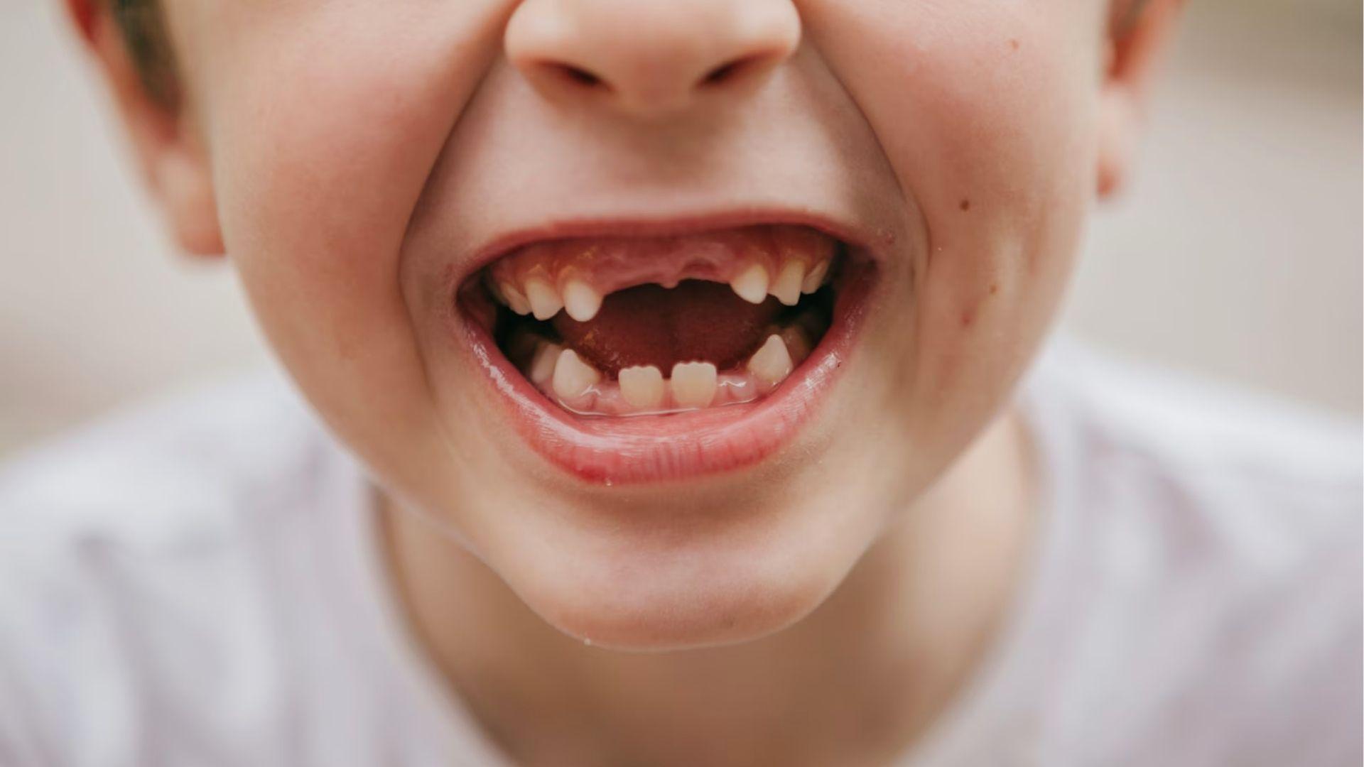 Happy boy with missing front baby teeth smiles wide, showing early tooth loss in childhood.