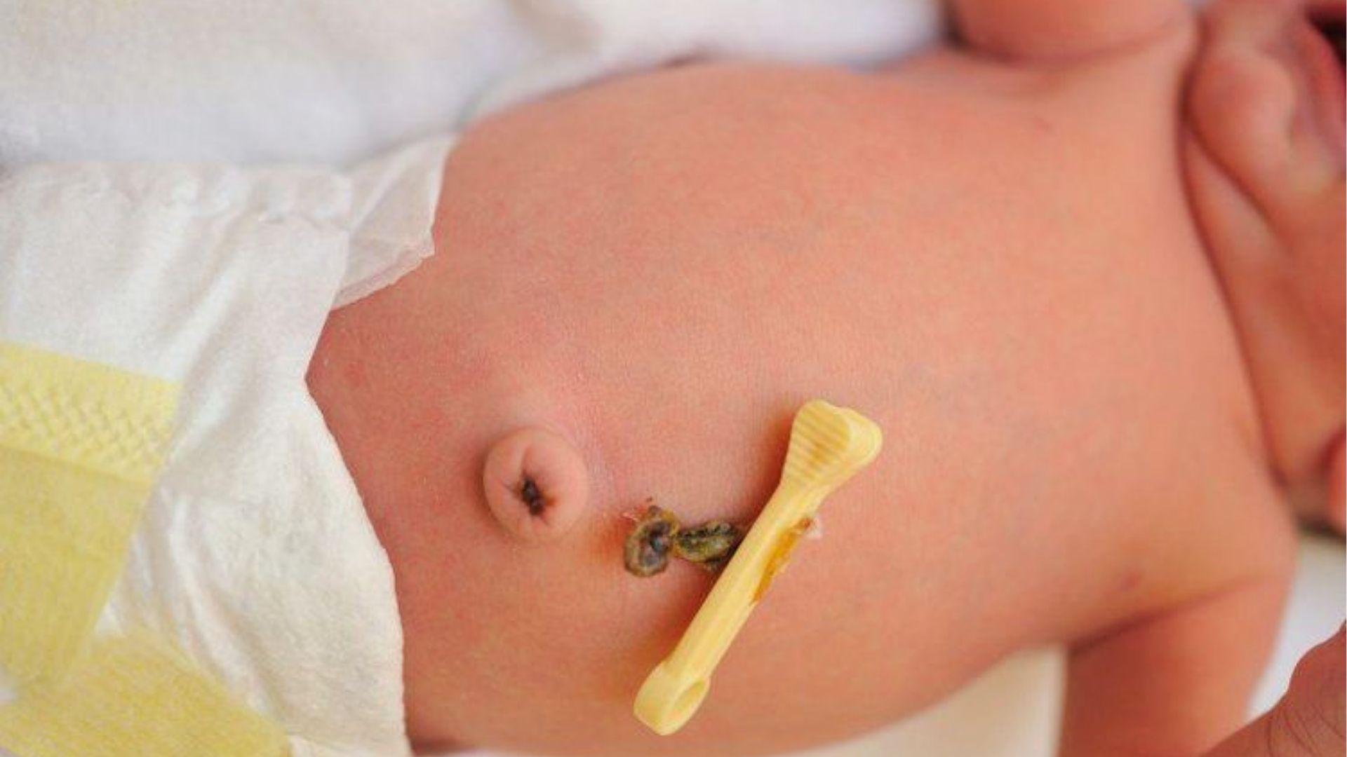Close-up of newborn belly with umbilical cord stump.